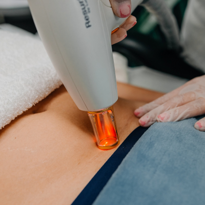 Удаление шрамов Lumenis M22