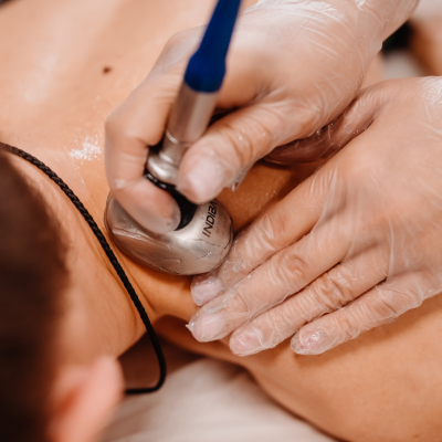 RF лифтинг спины